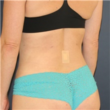 Liposuction After Photo by Steve Laverson, MD, FACS; San Diego, CA - Case 46241