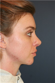 Rhinoplasty After Photo by Steve Laverson, MD, FACS; Rancho Santa Fe, CA - Case 46262