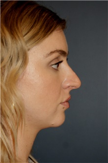 Rhinoplasty Before Photo by Steve Laverson, MD, FACS; San Diego, CA - Case 46262