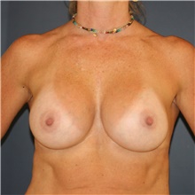 Breast Augmentation After Photo by Steve Laverson, MD, FACS; Rancho Santa Fe, CA - Case 46267