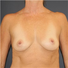Breast Augmentation Before Photo by Steve Laverson, MD; San Diego, CA - Case 46267