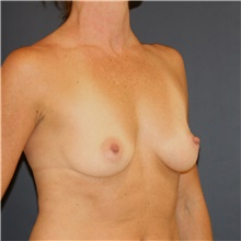 Breast Augmentation Before Photo by Steve Laverson, MD, FACS; Rancho Santa Fe, CA - Case 46267