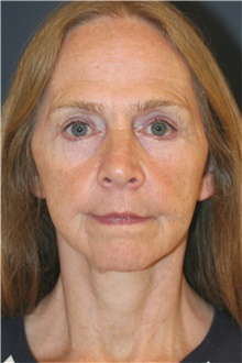 Facelift After Photo by Steve Laverson, MD, FACS; Rancho Santa Fe, CA - Case 46281