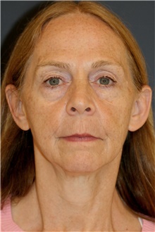 Facelift Before Photo by Steve Laverson, MD, FACS; Rancho Santa Fe, CA - Case 46281