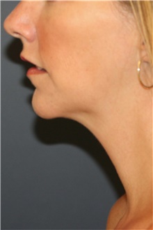 Chin Augmentation After Photo by Steve Laverson, MD; San Diego, CA - Case 46352