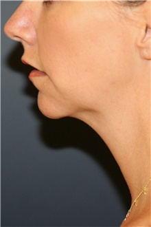 Chin Augmentation Before Photo by Steve Laverson, MD; San Diego, CA - Case 46352