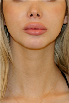 Chin Augmentation After Photo by Steve Laverson, MD, FACS; Rancho Santa Fe, CA - Case 46353