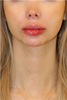 Chin Augmentation Before Photo by Steve Laverson, MD; San Diego, CA - Case 46353