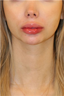 Chin Augmentation Before Photo by Steve Laverson, MD, FACS; San Diego, CA - Case 46353