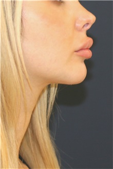 Chin Augmentation After Photo by Steve Laverson, MD, FACS; Rancho Santa Fe, CA - Case 46353