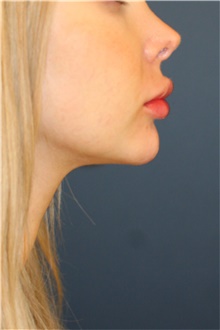 Chin Augmentation Before Photo by Steve Laverson, MD, FACS; San Diego, CA - Case 46353