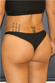 Buttock Lift with Augmentation After Photo by Steve Laverson, MD, FACS; Rancho Santa Fe, CA - Case 46360