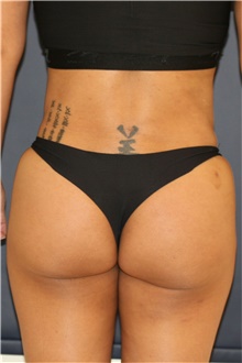 Buttock Lift with Augmentation After Photo by Steve Laverson, MD, FACS; Rancho Santa Fe, CA - Case 46360
