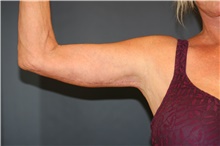 Arm Lift After Photo by Steve Laverson, MD, FACS; San Diego, CA - Case 46417