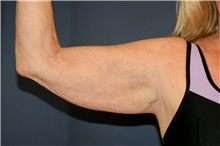 Arm Lift Before Photo by Steve Laverson, MD, FACS; Rancho Santa Fe, CA - Case 46417