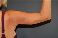 Arm Lift After Photo by Steve Laverson, MD, FACS; San Diego, CA - Case 46417