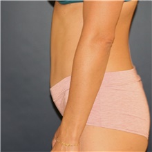 Tummy Tuck After Photo by Steve Laverson, MD; San Diego, CA - Case 46418