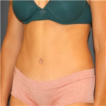 Tummy Tuck After Photo by Steve Laverson, MD, FACS; San Diego, CA - Case 46418