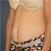 Tummy Tuck Before Photo by Steve Laverson, MD, FACS; San Diego, CA - Case 46418