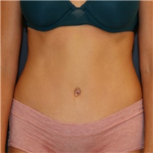 Tummy Tuck After Photo by Steve Laverson, MD, FACS; San Diego, CA - Case 46418