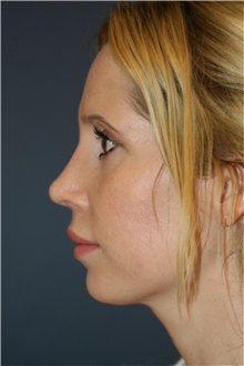 Rhinoplasty After Photo by Steve Laverson, MD, FACS; San Diego, CA - Case 46421