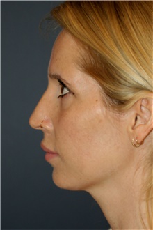 Rhinoplasty Before Photo by Steve Laverson, MD, FACS; San Diego, CA - Case 46421