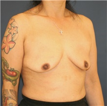 Breast Augmentation Before Photo by Steve Laverson, MD, FACS; Rancho Santa Fe, CA - Case 46422