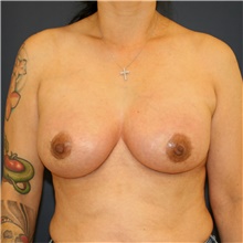 Breast Augmentation After Photo by Steve Laverson, MD, FACS; Rancho Santa Fe, CA - Case 46422