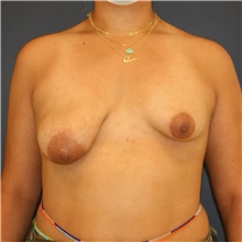 Breast Lift Before Photo by Steve Laverson, MD, FACS; San Diego, CA - Case 46592