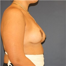 Breast Lift After Photo by Steve Laverson, MD, FACS; Rancho Santa Fe, CA - Case 46592