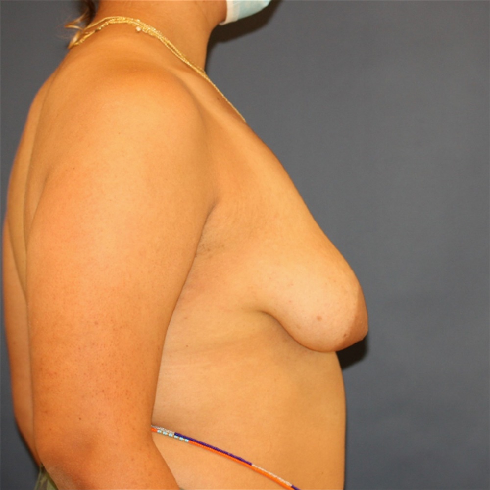 Breast Lift Surgery San Diego