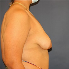 Breast Lift Before Photo by Steve Laverson, MD, FACS; San Diego, CA - Case 46592