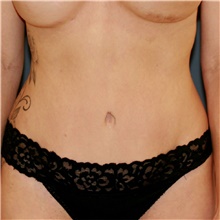 Tummy Tuck After Photo by Steve Laverson, MD, FACS; San Diego, CA - Case 46593