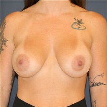 Breast Augmentation After Photo by Steve Laverson, MD, FACS; Rancho Santa Fe, CA - Case 46639