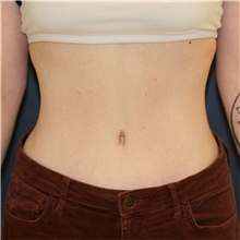 Tummy Tuck After Photo by Steve Laverson, MD; San Diego, CA - Case 46799