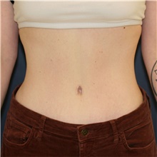 Tummy Tuck After Photo by Steve Laverson, MD, FACS; San Diego, CA - Case 46799