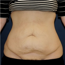 Tummy Tuck Before Photo by Steve Laverson, MD, FACS; San Diego, CA - Case 46799