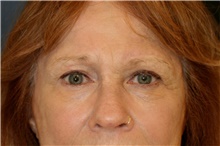 Brow Lift After Photo by Steve Laverson, MD; San Diego, CA - Case 46836