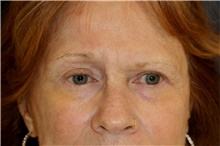 Brow Lift Before Photo by Steve Laverson, MD, FACS; San Diego, CA - Case 46836