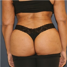 Liposuction After Photo by Steve Laverson, MD, FACS; San Diego, CA - Case 47098