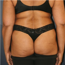 Liposuction Before Photo by Steve Laverson, MD, FACS; San Diego, CA - Case 47098