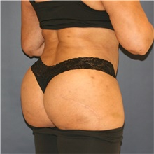 Liposuction After Photo by Steve Laverson, MD, FACS; Rancho Santa Fe, CA - Case 47098