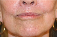 Lip Augmentation/Enhancement After Photo by Steve Laverson, MD, FACS; Rancho Santa Fe, CA - Case 47254