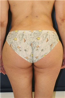 Buttock Lift with Augmentation After Photo by Steve Laverson, MD; San Diego, CA - Case 47256