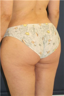 Buttock Lift with Augmentation After Photo by Steve Laverson, MD, FACS; Rancho Santa Fe, CA - Case 47256