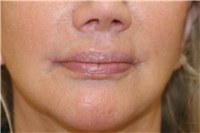 Lip Augmentation/Enhancement After Photo by Steve Laverson, MD, FACS; Rancho Santa Fe, CA - Case 47570