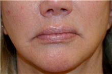 Lip Augmentation/Enhancement Before Photo by Steve Laverson, MD; San Diego, CA - Case 47570