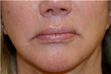 Lip Augmentation/Enhancement Before Photo by Steve Laverson, MD, FACS; Rancho Santa Fe, CA - Case 47570