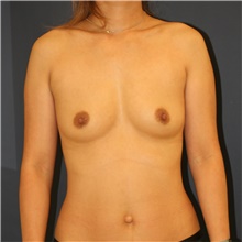 Breast Augmentation Before Photo by Steve Laverson, MD, FACS; Rancho Santa Fe, CA - Case 47571