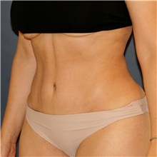 Tummy Tuck After Photo by Steve Laverson, MD, FACS; San Diego, CA - Case 47572